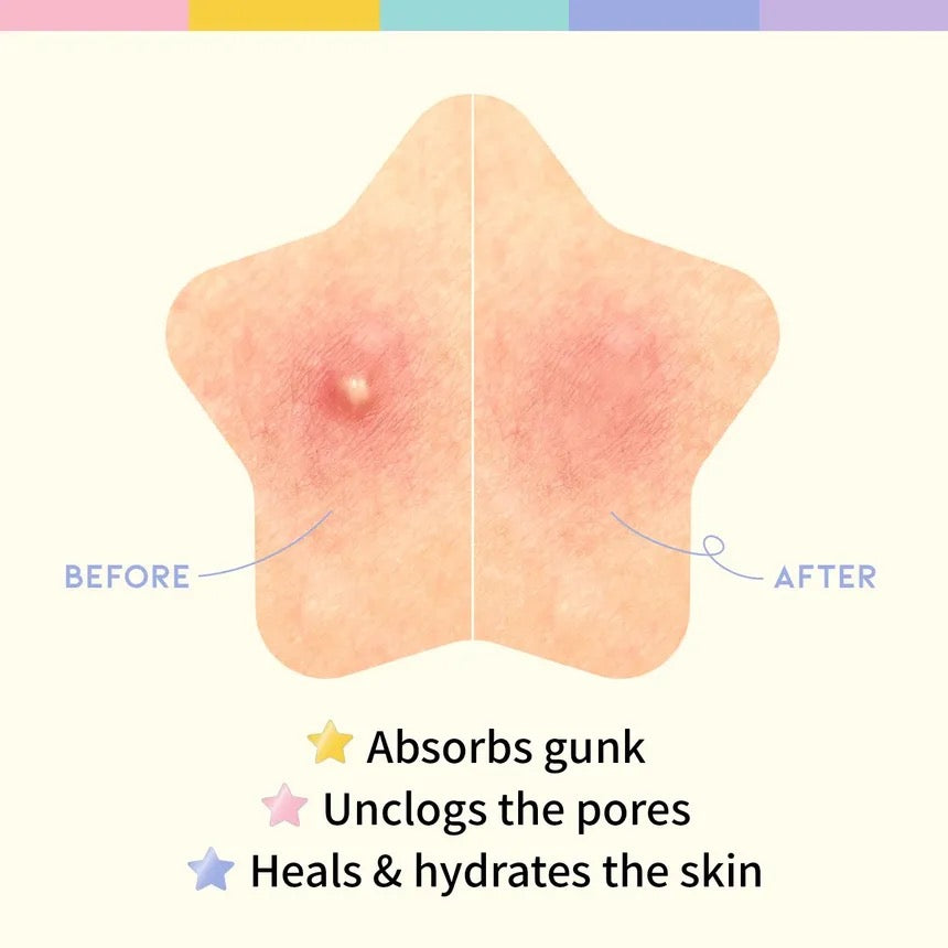 OOTD - Star Spot Pimple Patch [80 patches in Pack ]