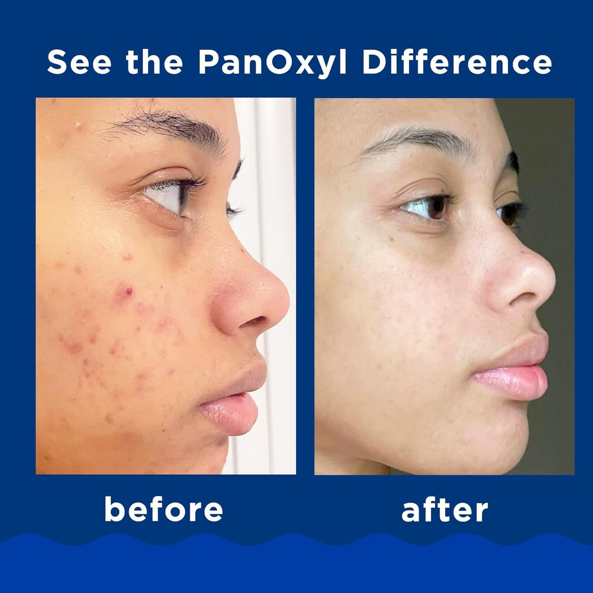 PanOxyl | Acne Creamy Wash with Benzoyl Peroxide Formula 10% benzoyl peroxide